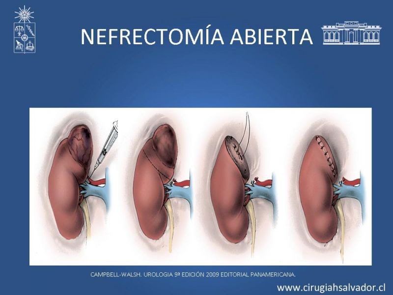 Diapositiva 15 de Nefrectomía técnica quirúrgica