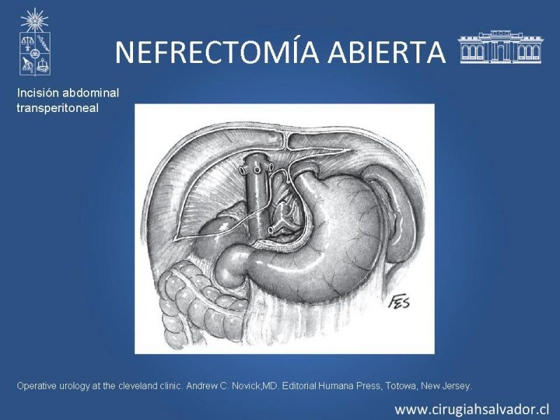 Diapositiva 10 de Nefrectomía técnica quirúrgica