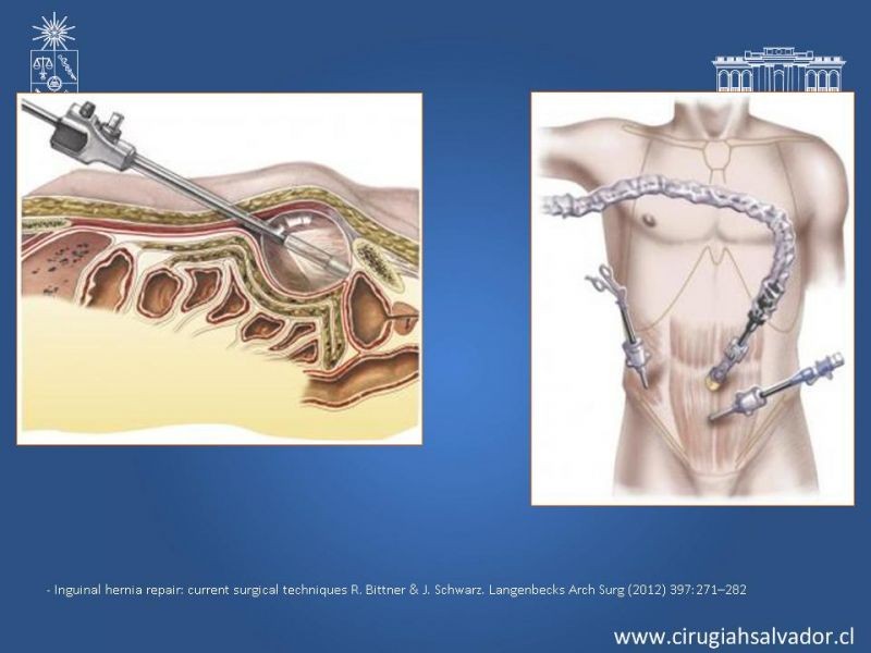 Diapositiva 24 de Alternativas actuales en el tratamiento de la Hernia Inguinal