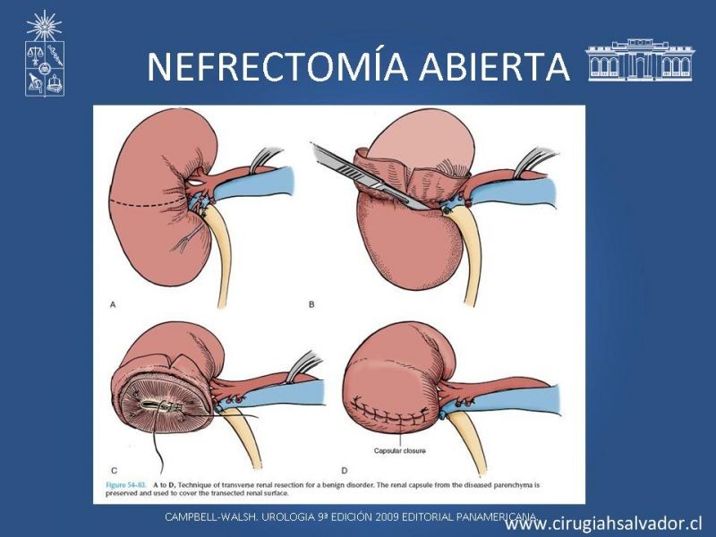 Diapositiva 16 de Nefrectomía técnica quirúrgica