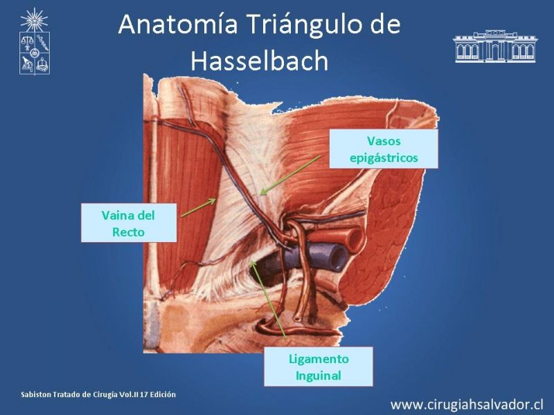 Diapositiva 7 de Alternativas actuales en el tratamiento de la Hernia Inguinal