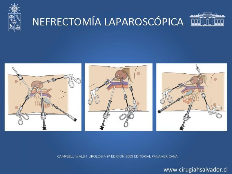 Diapositiva 22 de Nefrectomía técnica quirúrgica
