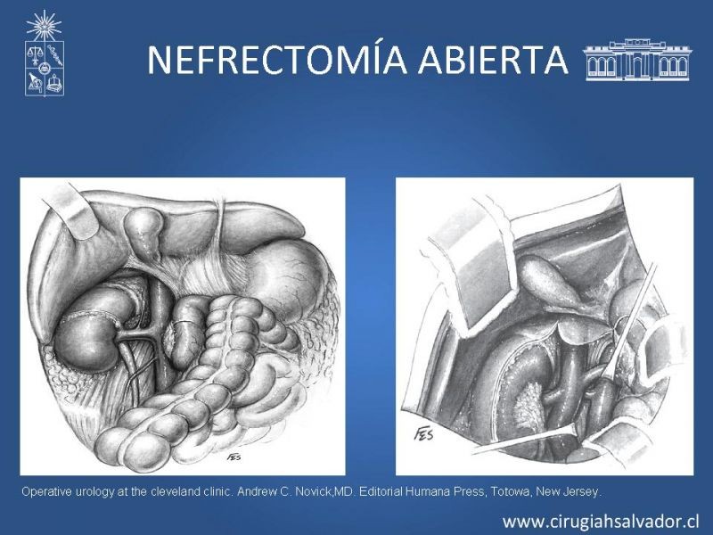 Diapositiva 11 de Nefrectomía técnica quirúrgica