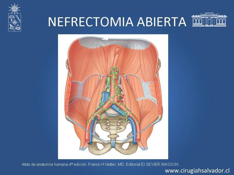 Diapositiva 14 de Nefrectomía técnica quirúrgica