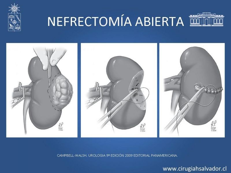 Diapositiva 17 de Nefrectomía técnica quirúrgica