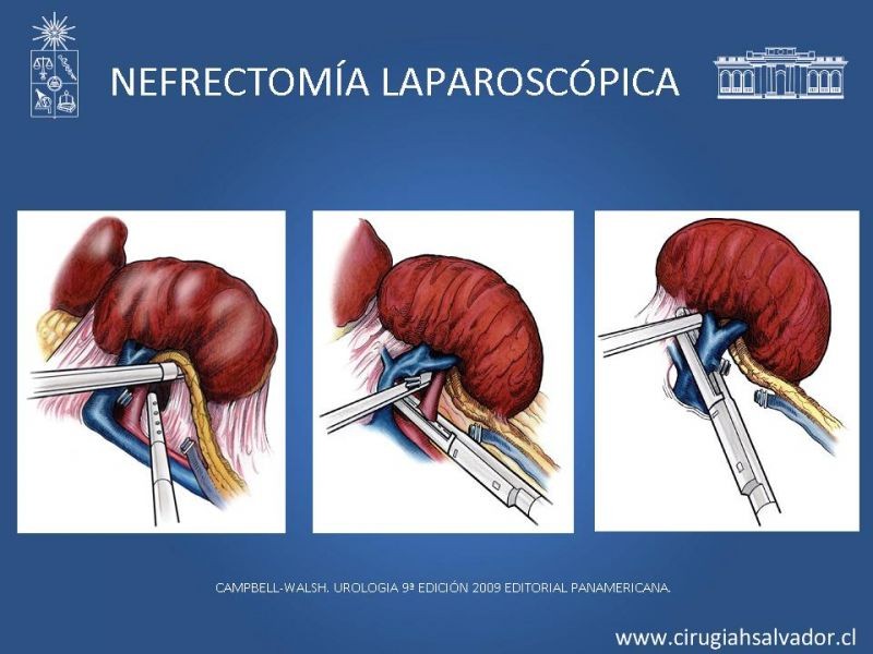 Diapositiva 25 de Nefrectomía técnica quirúrgica