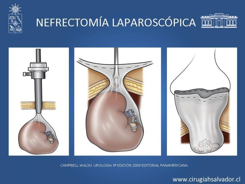 Diapositiva 27 de Nefrectomía técnica quirúrgica