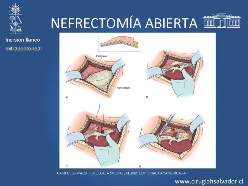 Diapositiva 8 de Nefrectomía técnica quirúrgica