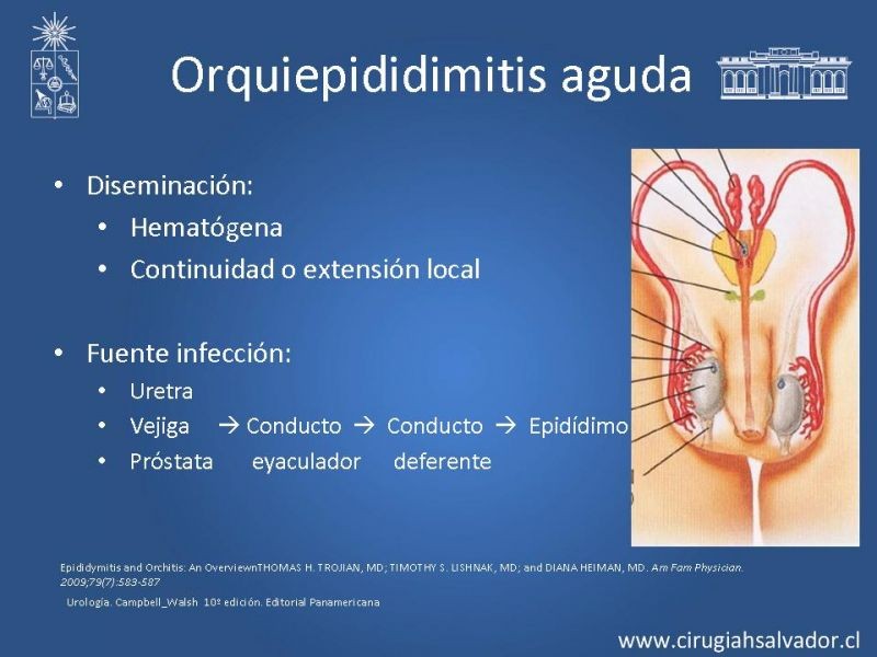 Diapositiva 21 de Escroto Agudo