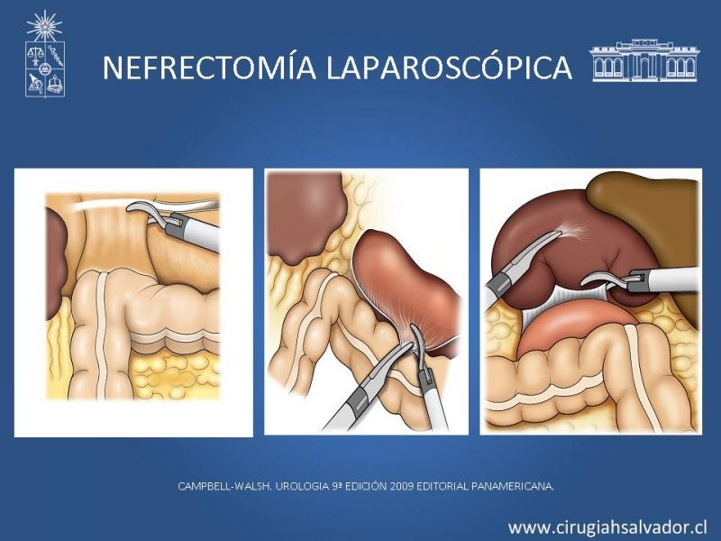 Diapositiva 23 de Nefrectomía técnica quirúrgica