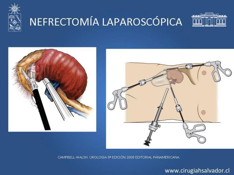 Diapositiva 26 de Nefrectomía técnica quirúrgica