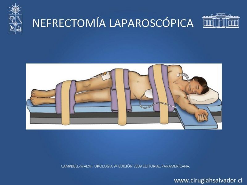 Diapositiva 20 de Nefrectomía técnica quirúrgica