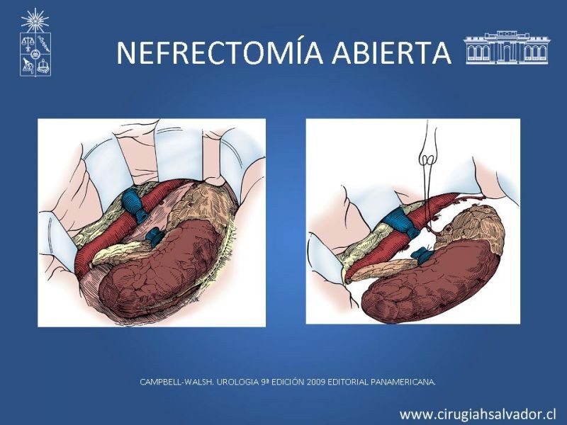 Diapositiva 13 de Nefrectomía técnica quirúrgica