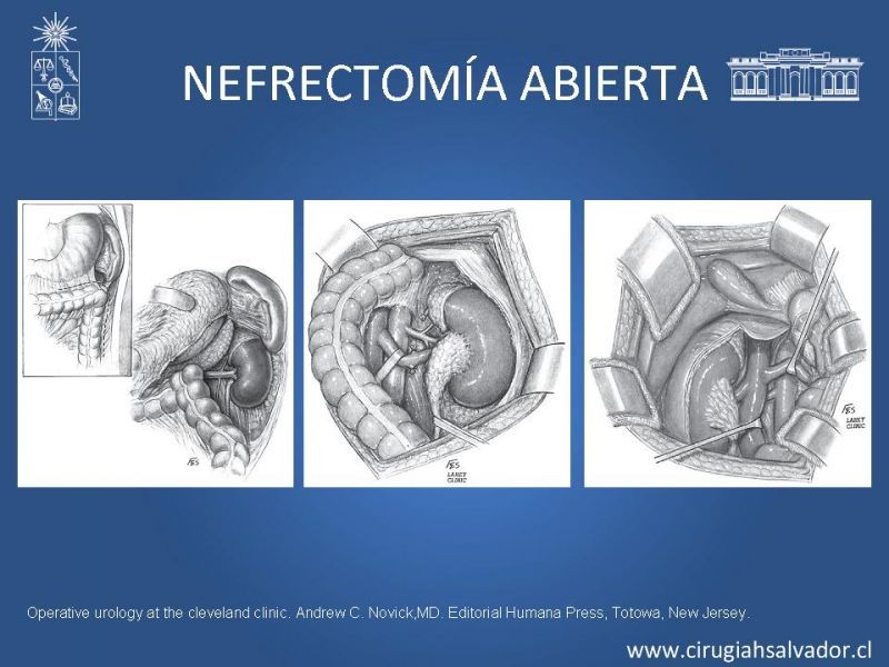 Diapositiva 12 de Nefrectomía técnica quirúrgica