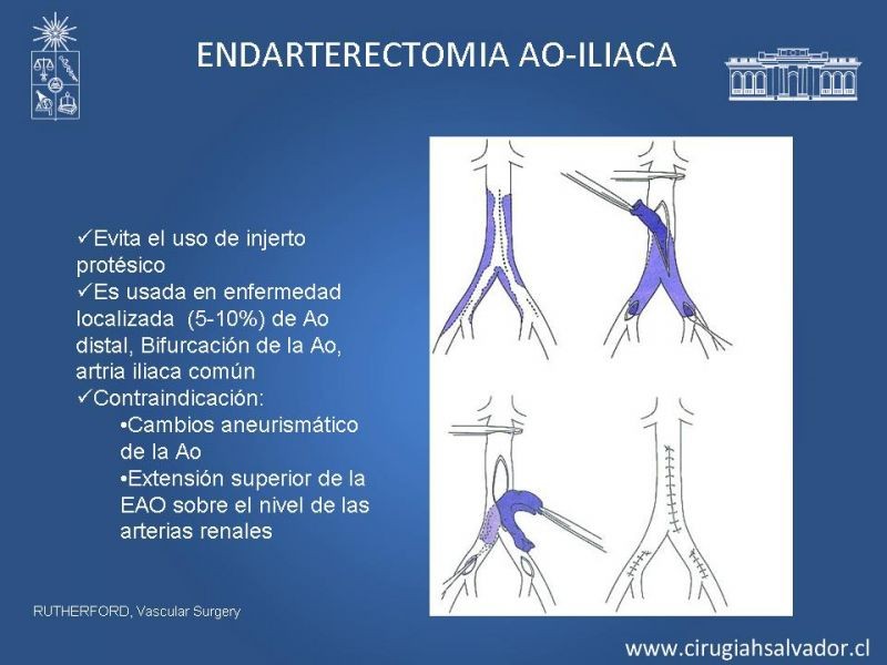 Diapositiva 17 de Manejo de Isquemia Critica de Extremidades Inferiores
