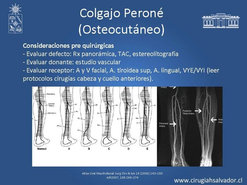 Diapositiva 17 de Alternativas de Reconstrucción Mandibular