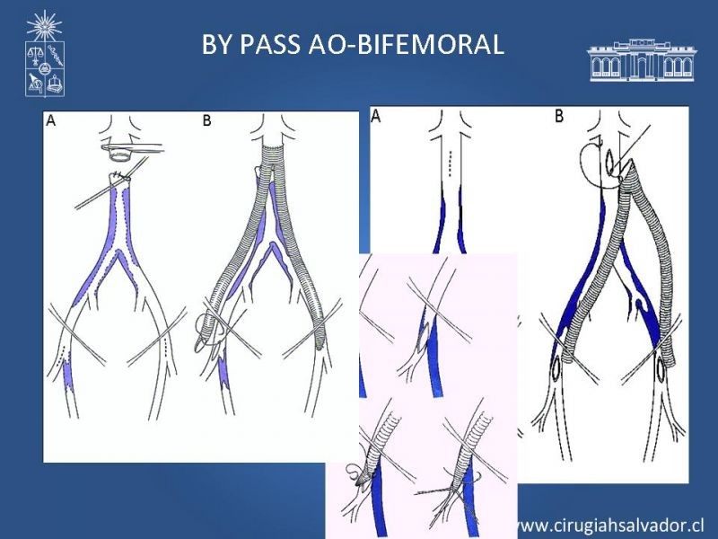 Diapositiva 20 de Manejo de Isquemia Critica de Extremidades Inferiores