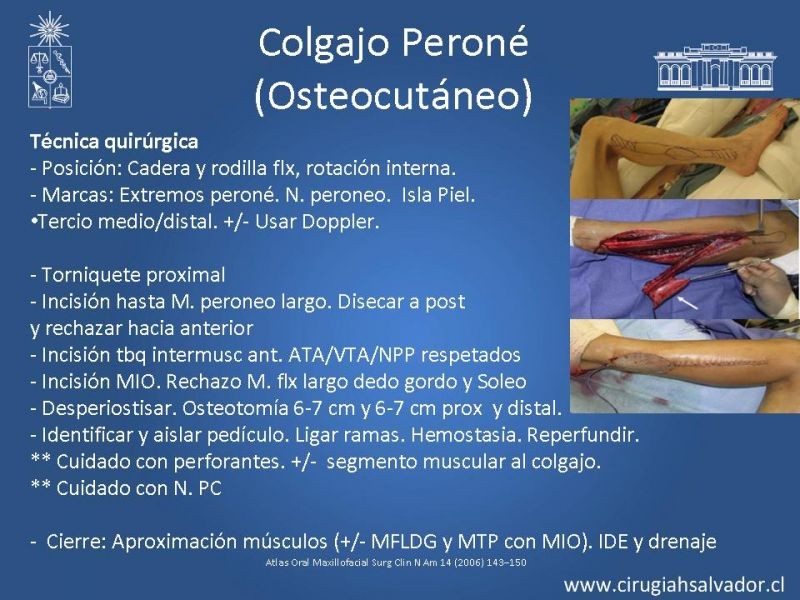 Diapositiva 18 de Alternativas de Reconstrucción Mandibular