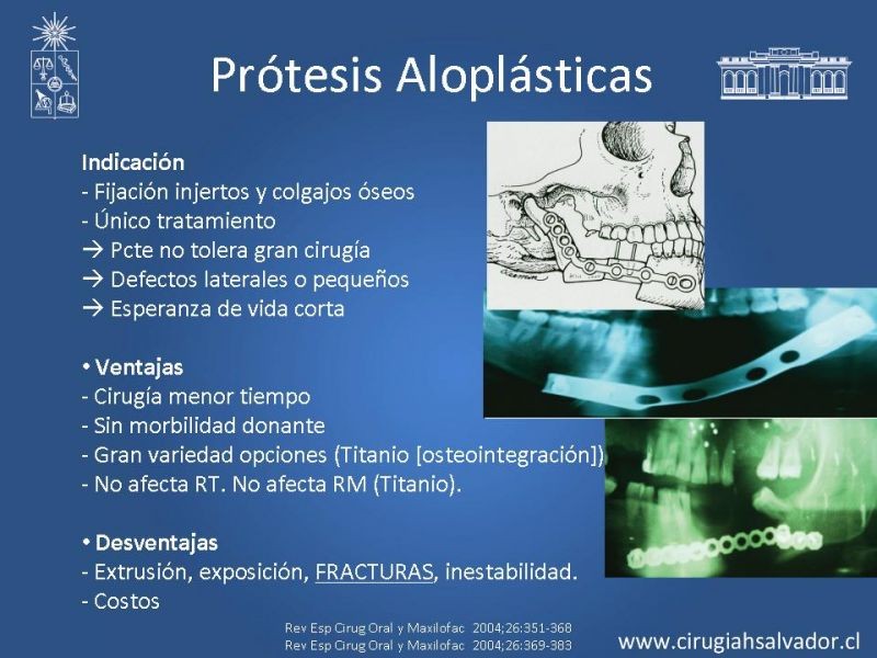Diapositiva 28 de Alternativas de Reconstrucción Mandibular