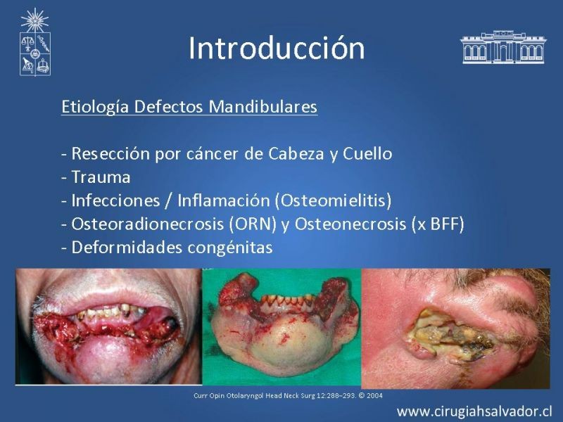 Diapositiva 1 de Alternativas de Reconstrucción Mandibular