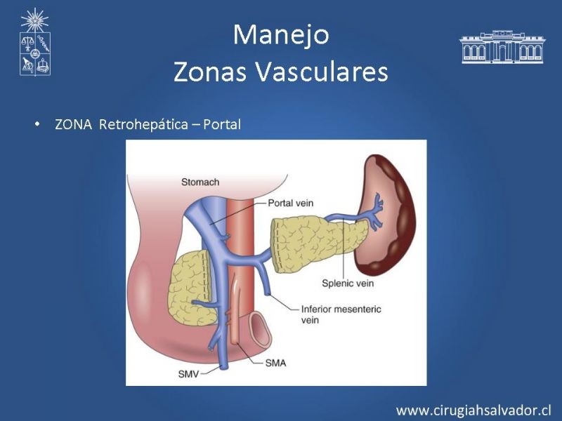 Diapositiva 38 de Lesiones Vasculares Abdominales