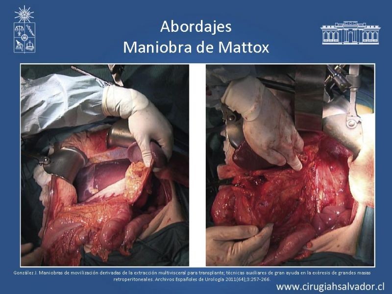 Diapositiva 26 de Lesiones Vasculares Abdominales