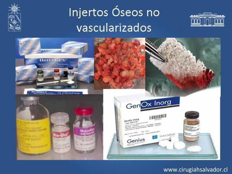 Diapositiva 12 de Alternativas de Reconstrucción Mandibular