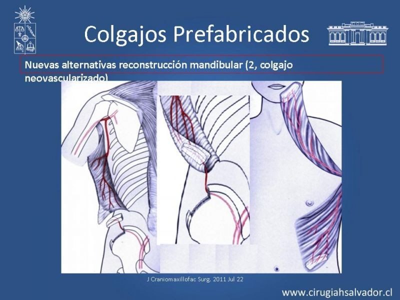 Diapositiva 32 de Alternativas de Reconstrucción Mandibular