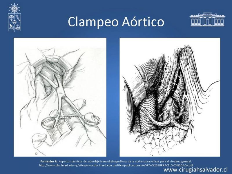 Diapositiva 20 de Lesiones Vasculares Abdominales