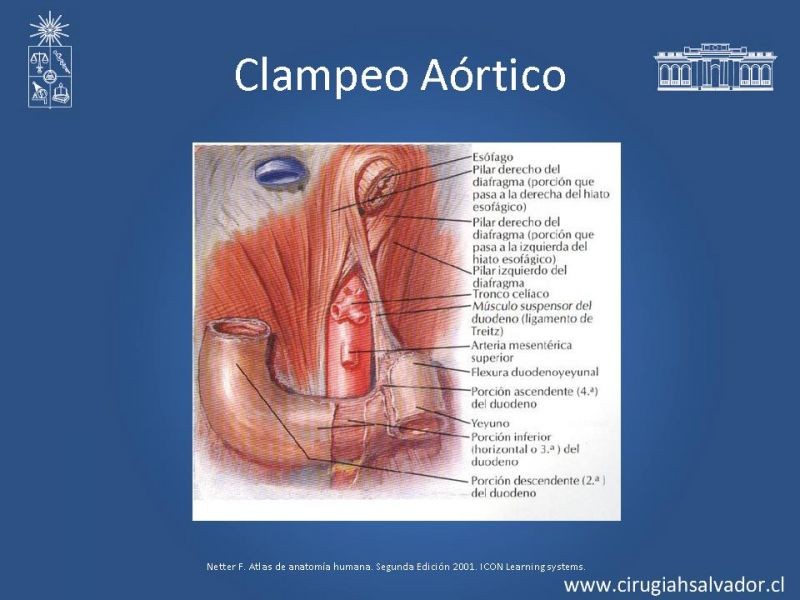 Diapositiva 19 de Lesiones Vasculares Abdominales