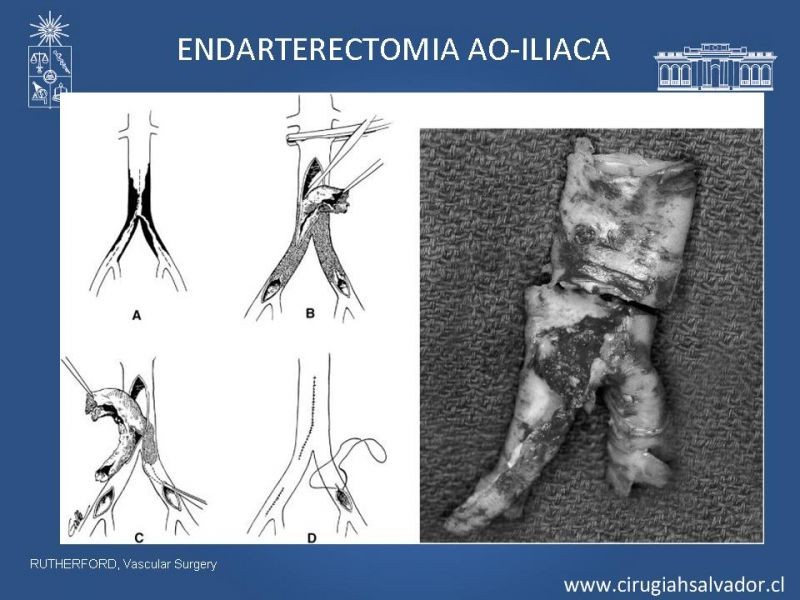 Diapositiva 18 de Manejo de Isquemia Critica de Extremidades Inferiores
