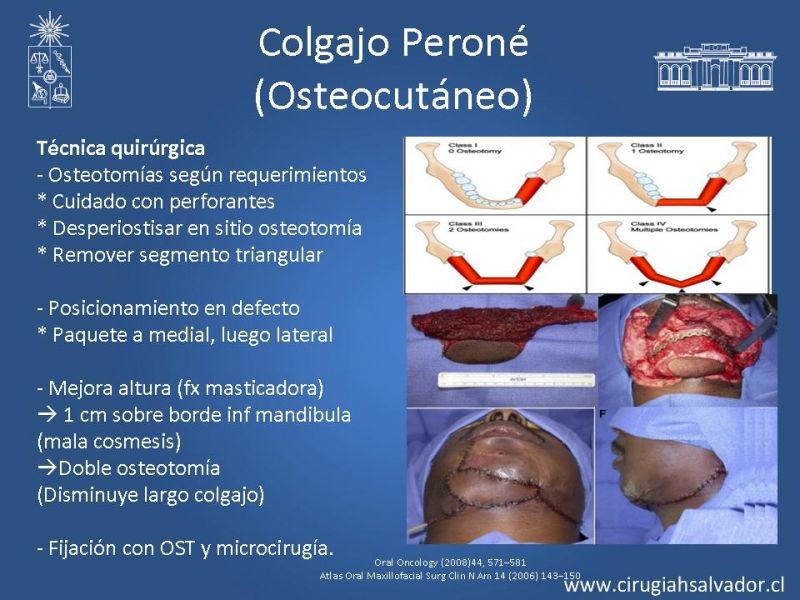 Diapositiva 20 de Alternativas de Reconstrucción Mandibular