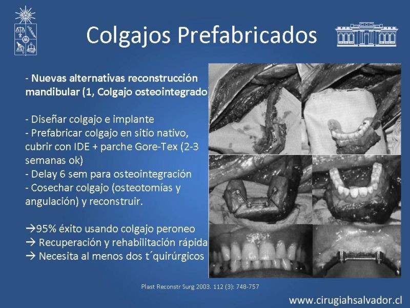 Diapositiva 30 de Alternativas de Reconstrucción Mandibular