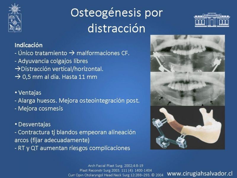 Diapositiva 29 de Alternativas de Reconstrucción Mandibular