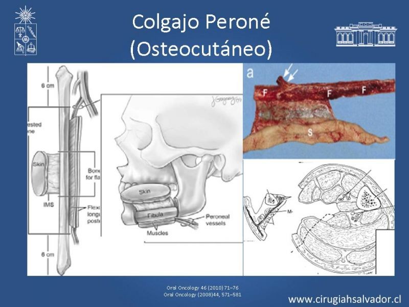 Diapositiva 19 de Alternativas de Reconstrucción Mandibular