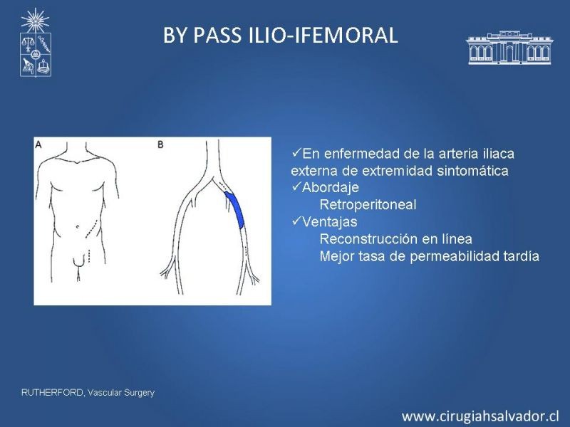 Diapositiva 21 de Manejo de Isquemia Critica de Extremidades Inferiores