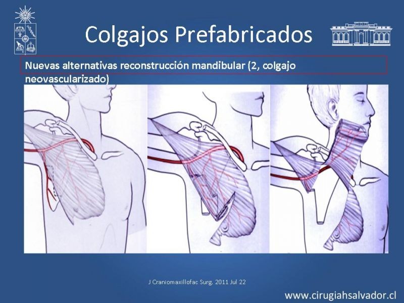Diapositiva 33 de Alternativas de Reconstrucción Mandibular