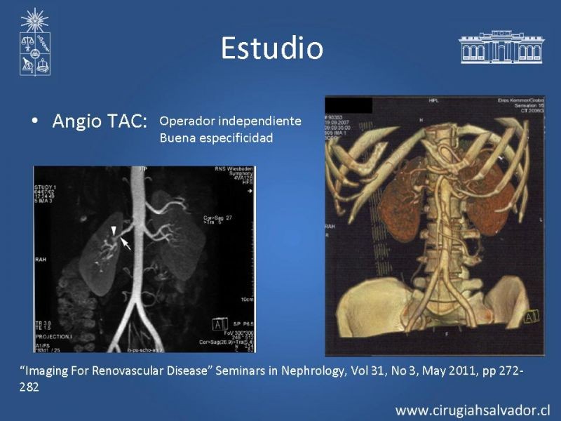 Diapositiva 12 de Hipertensión Renovascular
