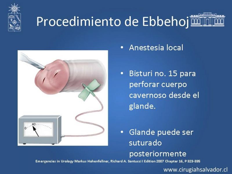 Diapositiva 20 de Priapismo
