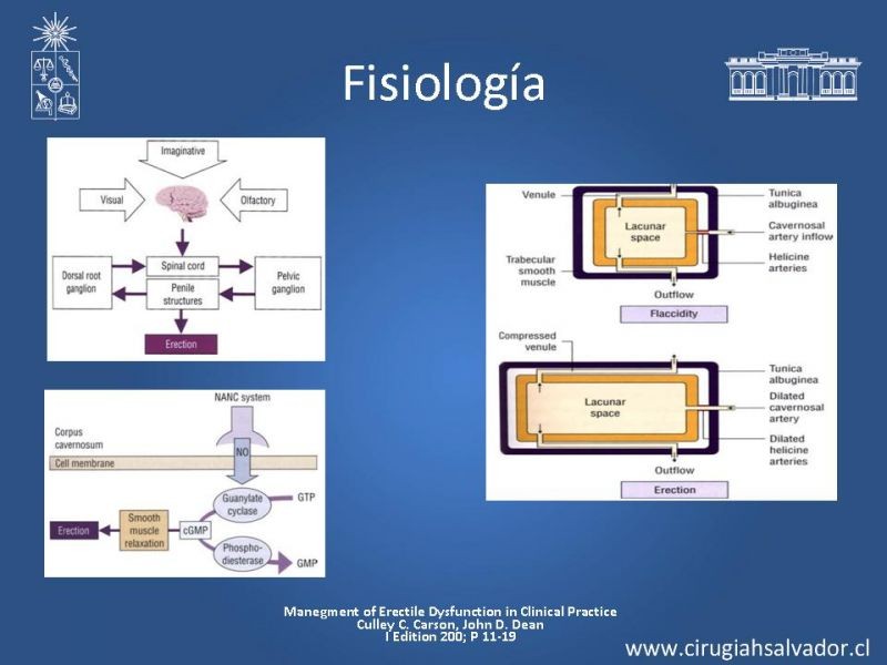 Diapositiva 4 de Priapismo