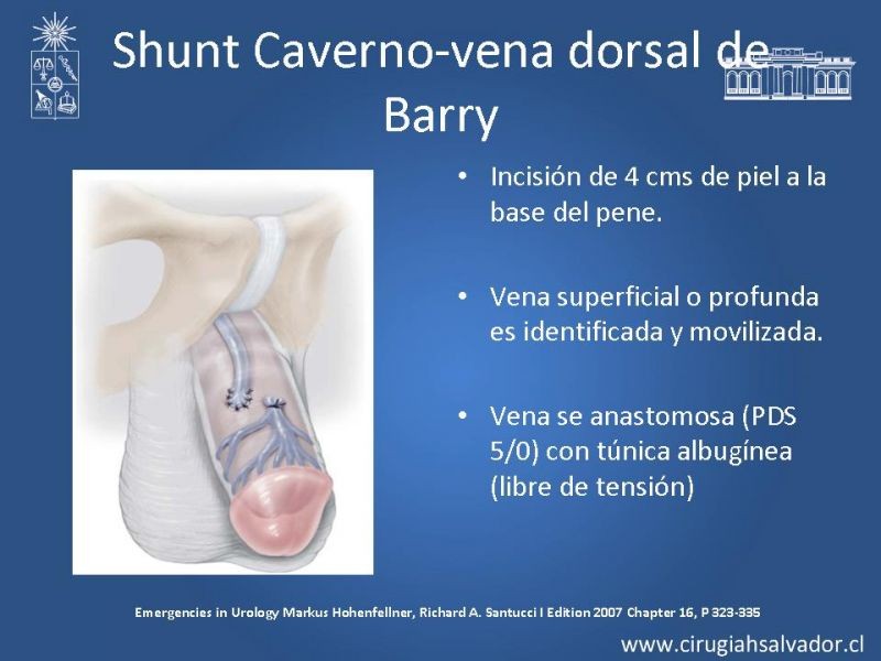 Diapositiva 23 de Priapismo