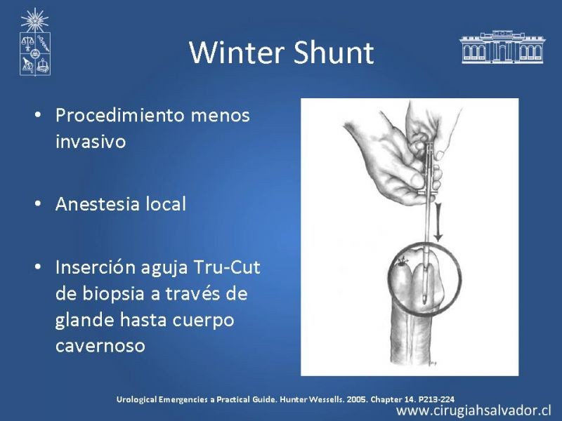 Diapositiva 19 de Priapismo