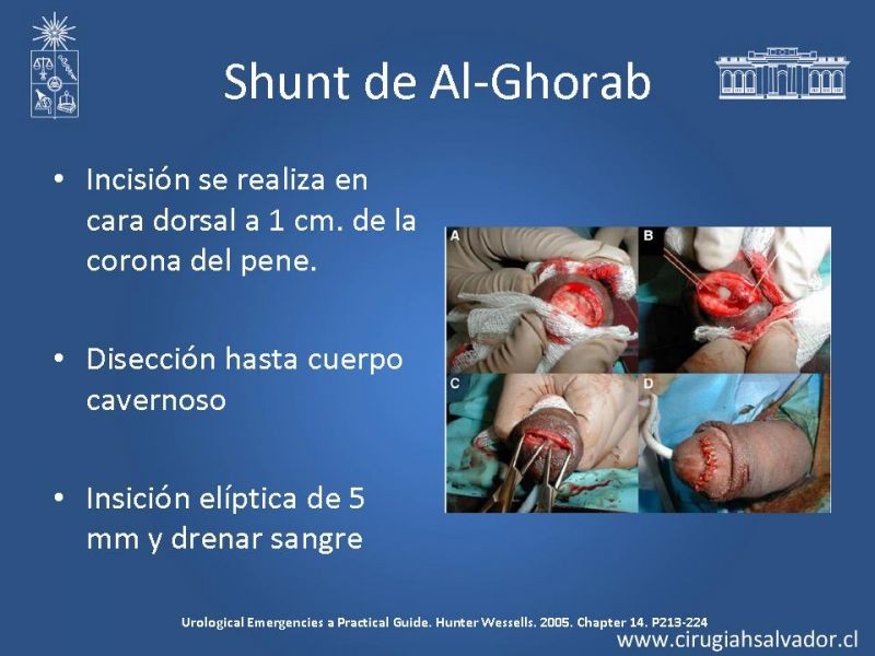 Diapositiva 21 de Priapismo