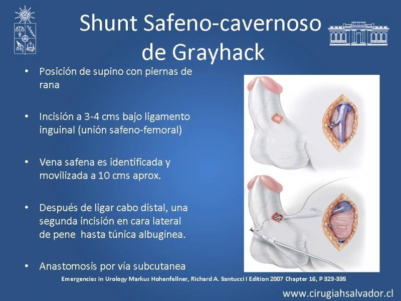 Diapositiva 24 de Priapismo