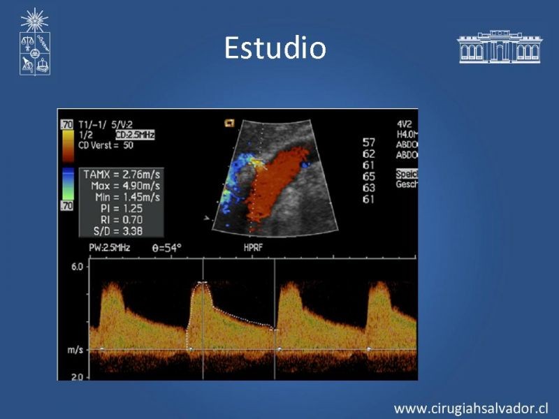 Diapositiva 10 de Hipertensión Renovascular