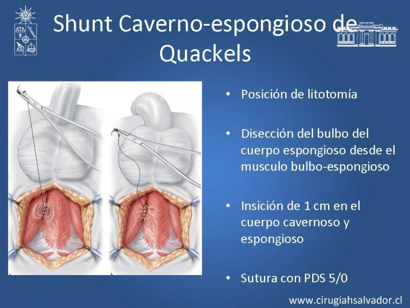 Diapositiva 22 de Priapismo