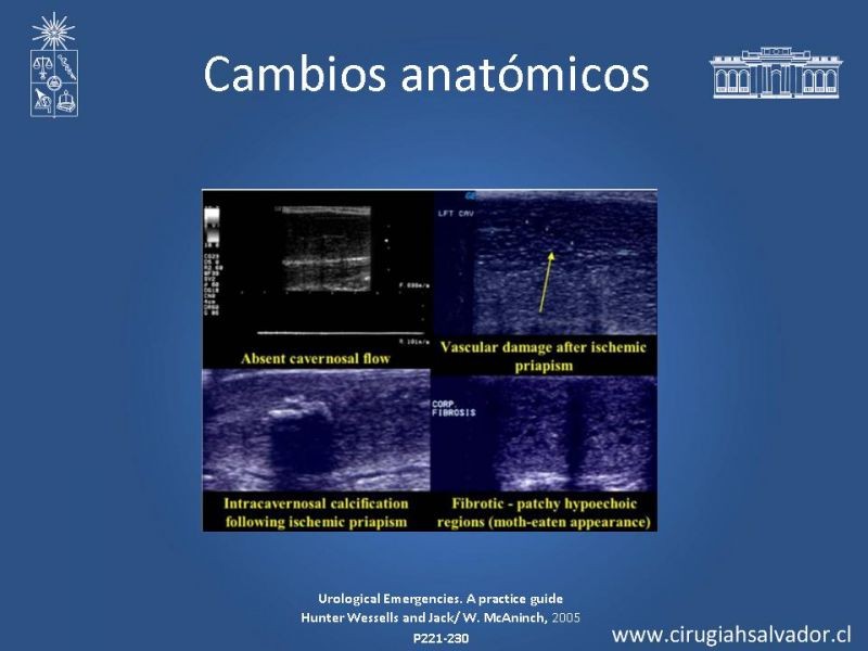Diapositiva 8 de Priapismo