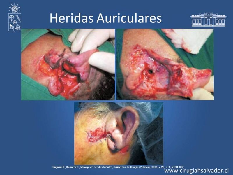 Diapositiva 32 de Heridas faciales complejas