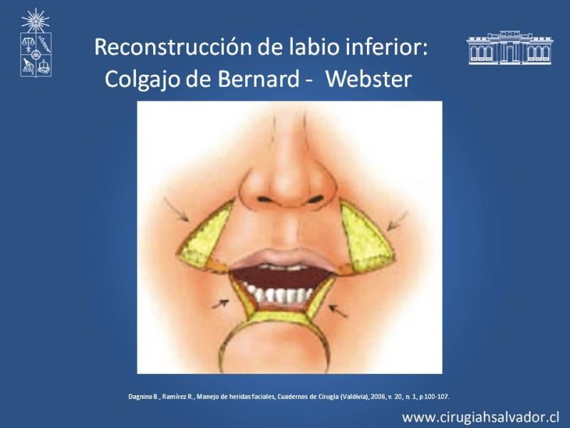 Diapositiva 30 de Heridas faciales complejas