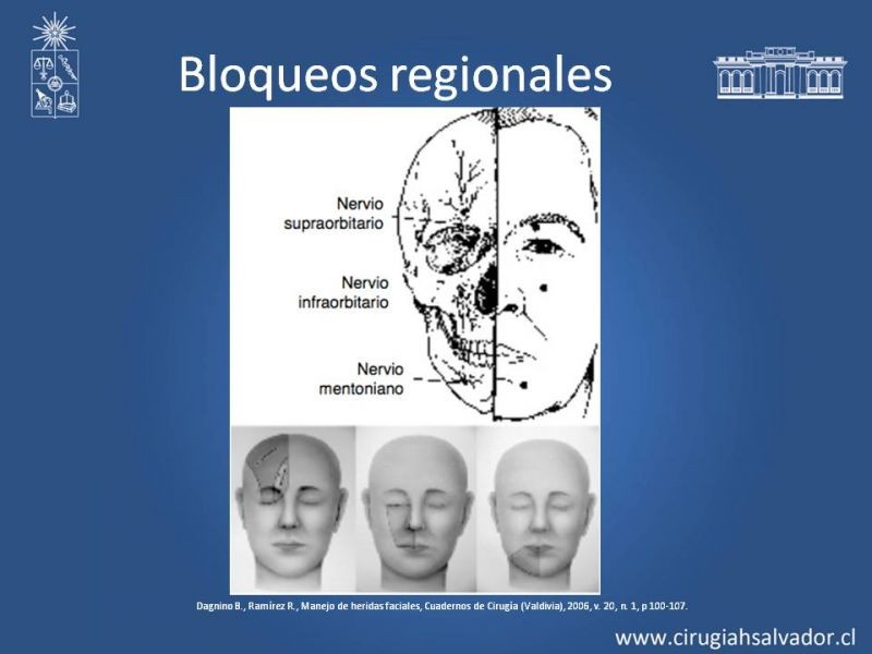 Diapositiva 11 de Heridas faciales complejas